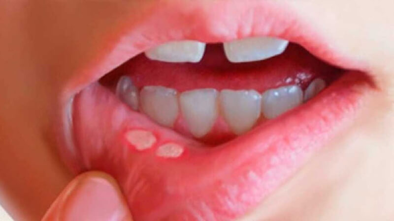 Bị nhiệt miệng uống thuốc gì để bệnh hồi phục nhanh?