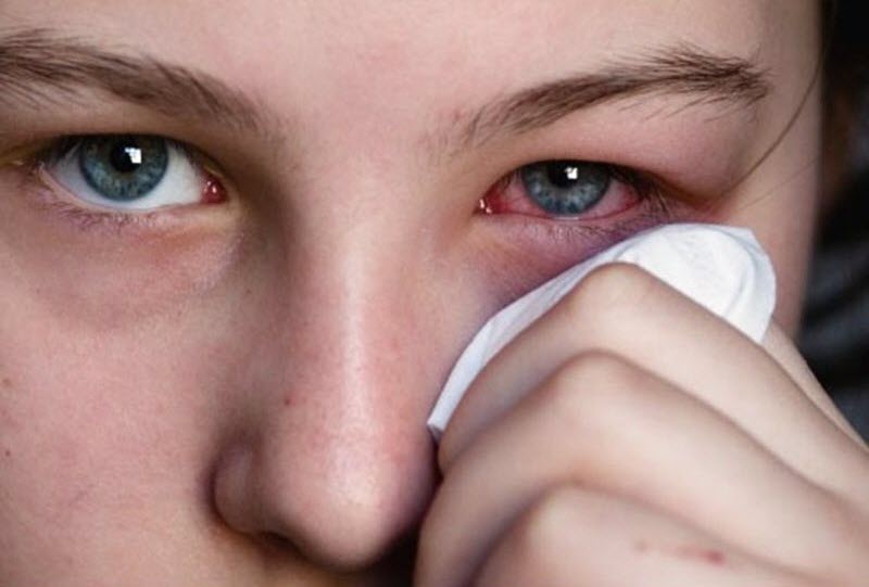 Bỏ túi mẹo trị đau mắt đỏ nhanh chóng, hiệu quả tại nhà